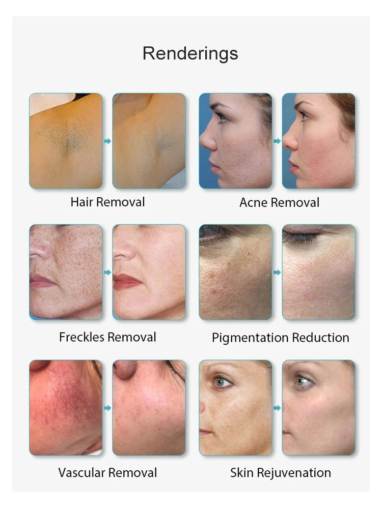 Multifunctional IPL Laser Hair Removal Salon Equipment Skin Rejuvenation Facial Whitening Wrinkle Removal Acne Treatment Beauty Machine IPL Opt Laser