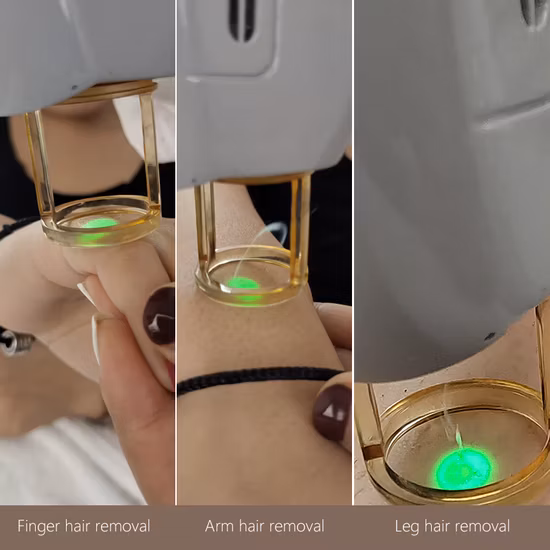 Alexandrite 755nm1064nm Long Pulse ND YAG Laser Gentle Alex PRO Laser Max Hair Removal
