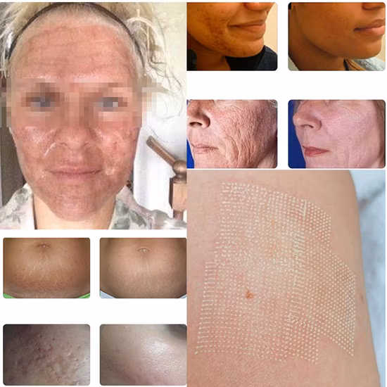 2022 Factory Direct CO2 Laser Scar Removal CO2 Fractional Laser Machine