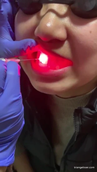 Diode Dental Soft Tissue Laser Dental Surgery Gum Laser Class IV Diode Laser 980nm for Dental Clinic Device